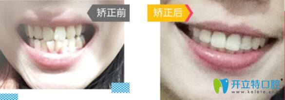 廣州哪里做牙齒正畸好？來看廣大口腔牙齒矯正前后對比圖