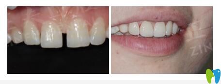 正夫口腔矯正牙縫大效果圖 正夫口腔矯正牙縫大效果圖