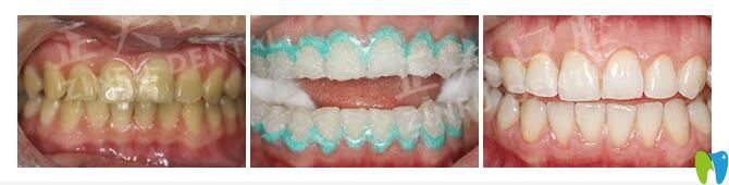 正夫口腔激光牙齒美白案例 正夫口腔激光牙齒美白案例