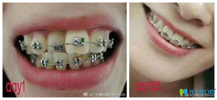 牙齒擁擠不齊，個(gè)別反頜小姐姐也來(lái)打卡啦