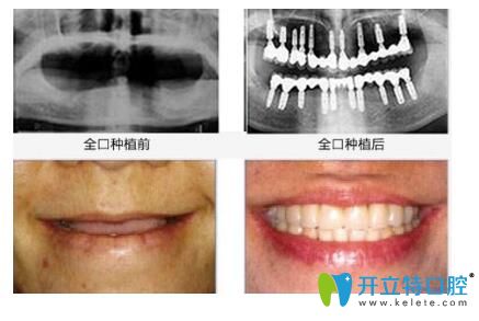 德韓口腔種植牙前后效果對(duì)比圖