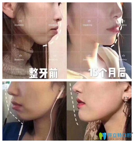 廣州壹加壹矯正牙齒好嗎？小姐姐在壹加正畸打卡記錄公開