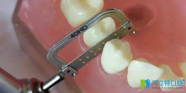 鄰面去釉后悔了，哪些情況可以做鄰面去釉？