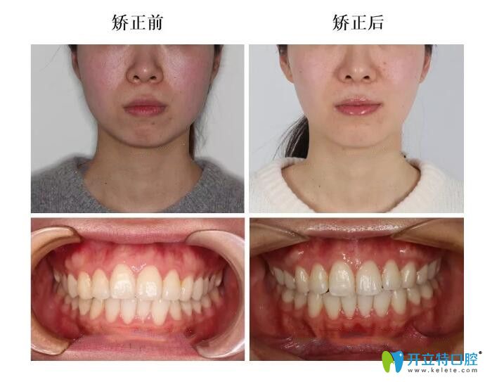 常州北極星口腔矯正前后對(duì)比圖