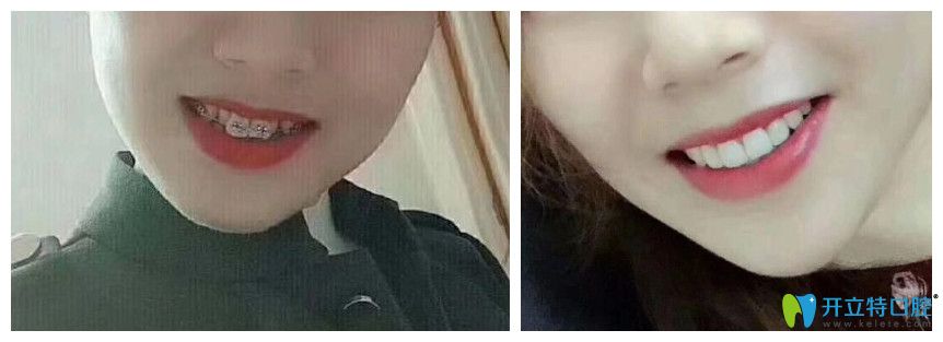 壹加壹門牙是兔牙的顧客矯正案例