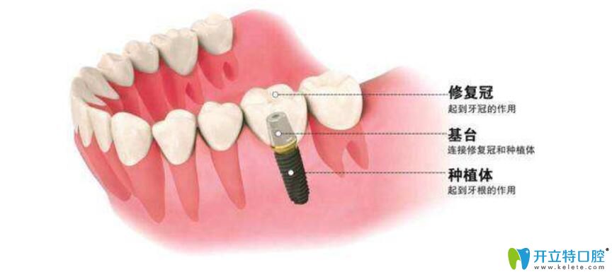 了解種牙牙冠價(jià)格前，先弄清楚種植牙牙冠有哪些種類