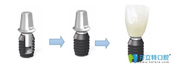 美國bicon種植體修復(fù)過程圖