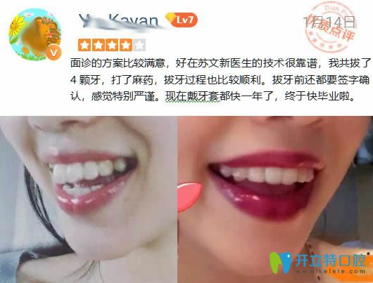 廣州壹加壹口腔成人齙牙矯正前后對(duì)比療效圖及評(píng)價(jià)