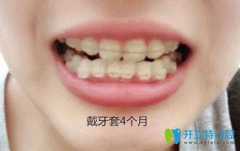我在梅州中大口腔做牙齒矯正第4個(gè)月