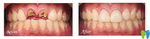 惠州致美口腔種植牙案例