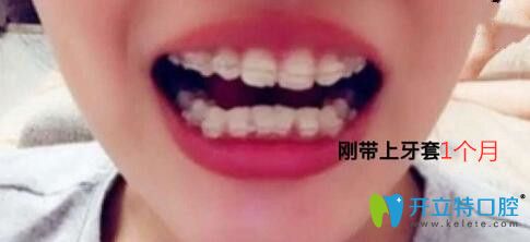 我在梅州中大口腔做牙齒矯正第1個(gè)月