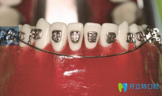 正畸搖椅弓該如何使用