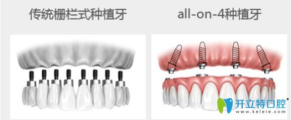 曲獻(xiàn)民科普：All-on-four全口種植優(yōu)勢體
