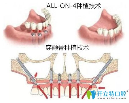 牙槽骨萎縮種植技術(shù)