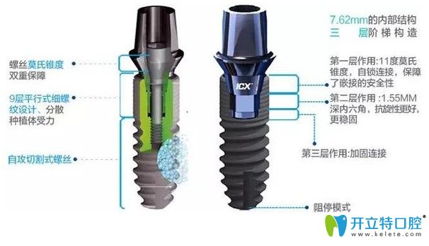 德國(guó)icx種植體優(yōu)點(diǎn)