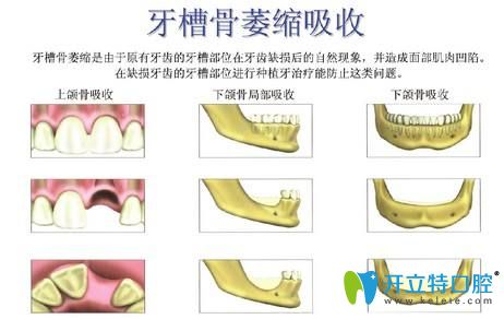 牙槽骨萎縮就不能做種植牙了嗎？NO,補救方法來啦！