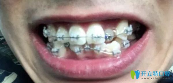 剛戴上牙套時(shí)的樣子