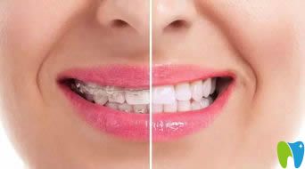 李永信醫(yī)生在矯正牙齒同時注重塑造美麗笑線