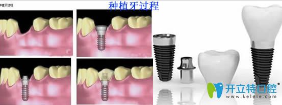 韓國(guó)各品牌的種植牙過(guò)程