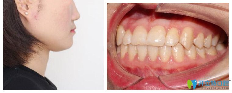 廣州廣大口腔正頜正畸治療后照片
