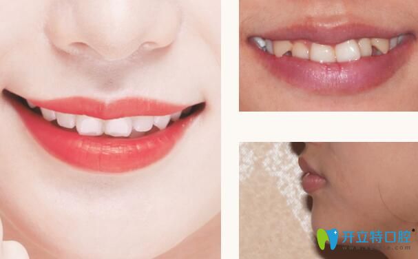 深圳格倫菲爾口腔矯正牙齒怎么樣呢？來(lái)看看真人正畸案例