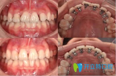 佛山拜爾口腔成人牙齒美學(xué)矯正案例效果圖