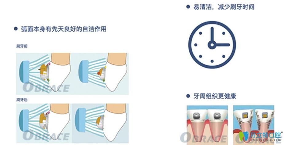 obrace球面自鎖托槽于有哪些優(yōu)勢