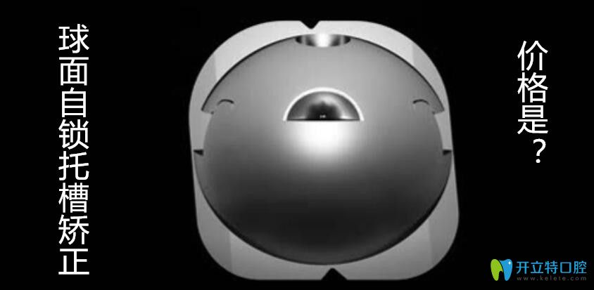 球面自鎖托槽OBrace矯正的價格是多少