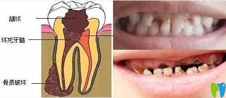 兒童乳牙齲壞真實寫照