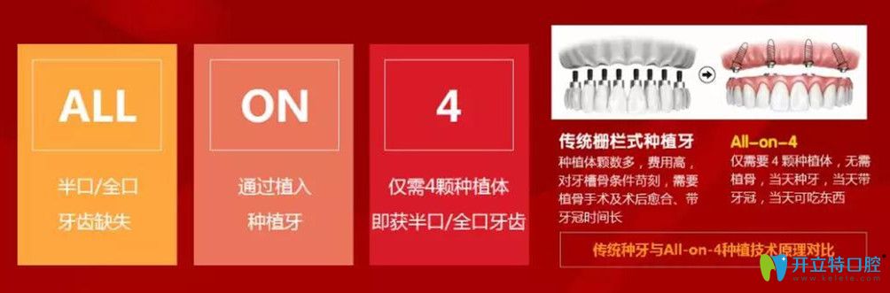 北極星口腔All-on-4即刻負(fù)重種植技術(shù)