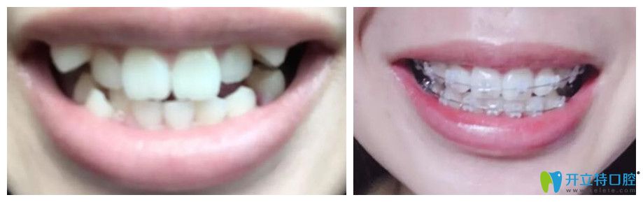 沈陽百嘉麗口腔牙齒矯正對比圖