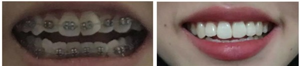 福州正畸多少錢?我在艾尚美口腔做矯正花了1.5萬元,效果不錯