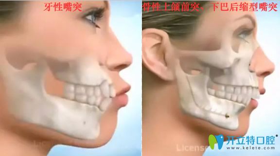 牙性突嘴和骨性上頜前突下巴后縮嘴突對(duì)比照