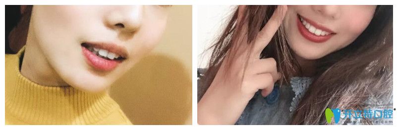 泰州北極星口腔隱形矯正案例前后效果對(duì)比圖