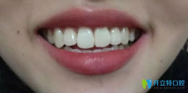 牙齒矯正前后對(duì)比圖