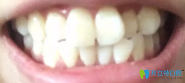 矯正前牙齒的情況