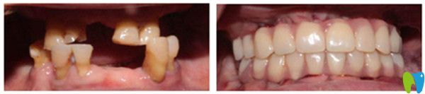 All-on-4全口種植牙前后對比圖 All-on-4全口種植牙前后對比圖