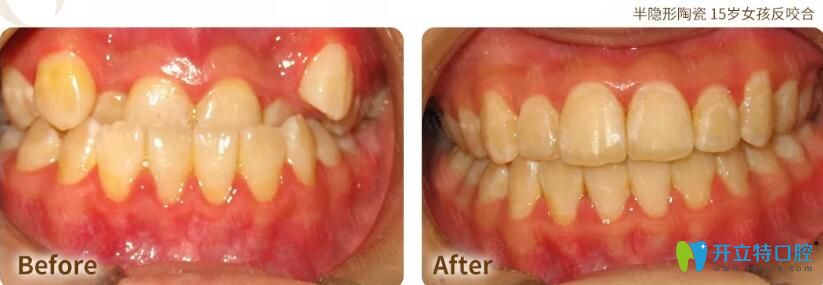 從東莞好佰年口腔案例及評(píng)價(jià)來(lái)判斷好佰年口腔好不好