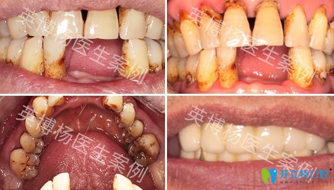 <!--<i data=20240703-sp></i>-->英博口腔種植牙好不好？來看夏偉院長種植牙過程案例
