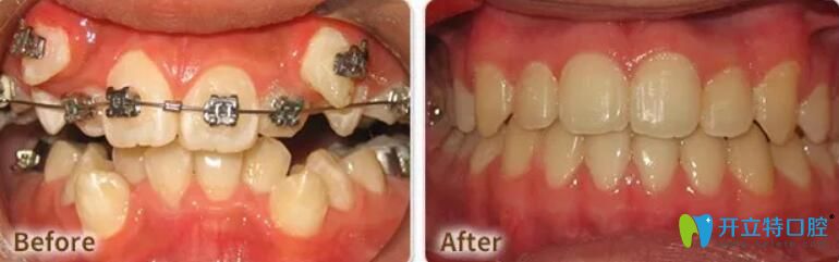 東莞好佰年口腔虎牙矯正案例前后效果對(duì)比