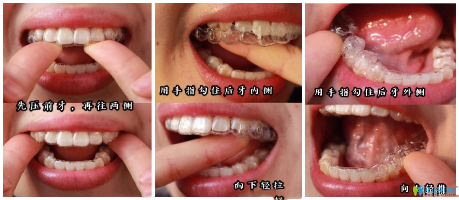 一定要掌握牙套的正確摘戴方法