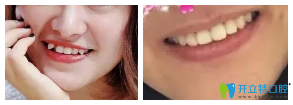 長春超龍牙博士口腔隱形牙齒矯正案例