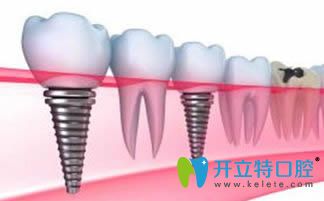 周宇醫(yī)生擅長(zhǎng)各類(lèi)種植牙技術(shù)