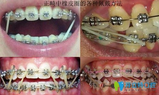 正畸中橡皮圈的各種掛法示意圖
