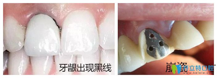 網(wǎng)傳烤瓷牙拆除很痛苦是真的嗎？