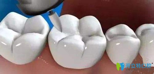 洗牙后要進行牙齒拋光處理
