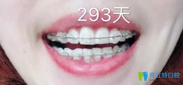 半隱形托槽前后對比照 半隱形托槽前后對比照