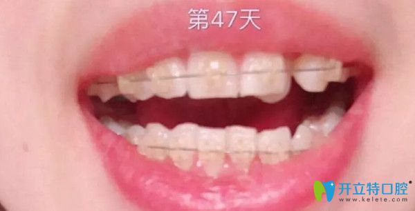 陶瓷托槽矯正第1個月 陶瓷托槽矯正第1個月
