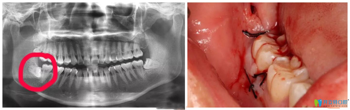 超聲骨刀拔牙真實(shí)案例