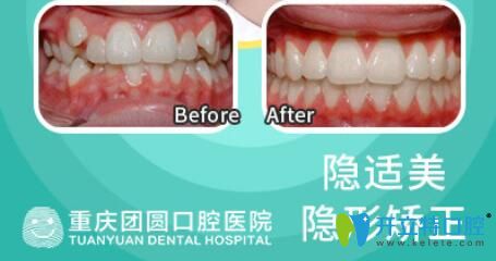 隱適美隱形矯正虎牙前后效果對比照片